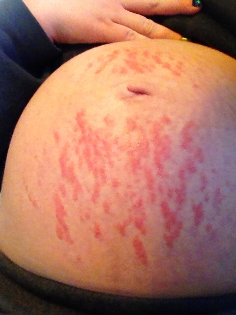 pupps pregnancy rash #9
